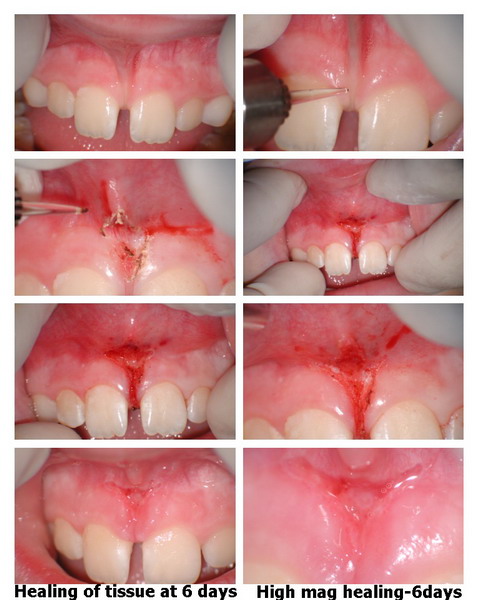 Frenectomy collage_resize.jpg